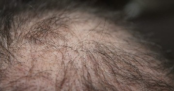 Áttörés a hajhullás kezelésében: ígéretes eredményeket hozott a clascoterone